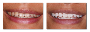 Teeth Whitening before and after image